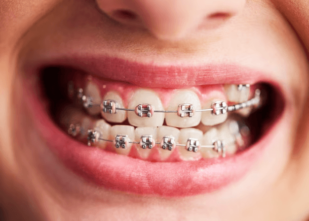 How to use dental wax on braces